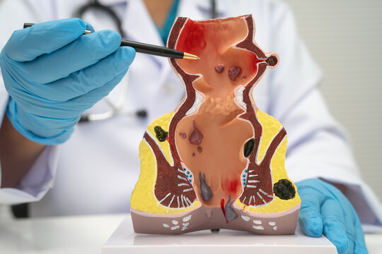Asian doctor with rectum and hemorrhoid human model, inflamed vascular structure.