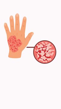 animation progressive dermatological skin disease on hand surface