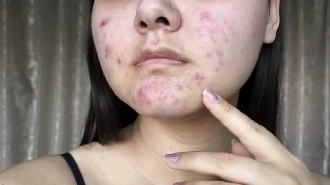 Acne, acne, redness on teenage facial skin. Problem skin in a teenage girl