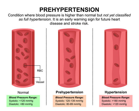 Prehypertension, Blood Pressure Medical Flashcard 