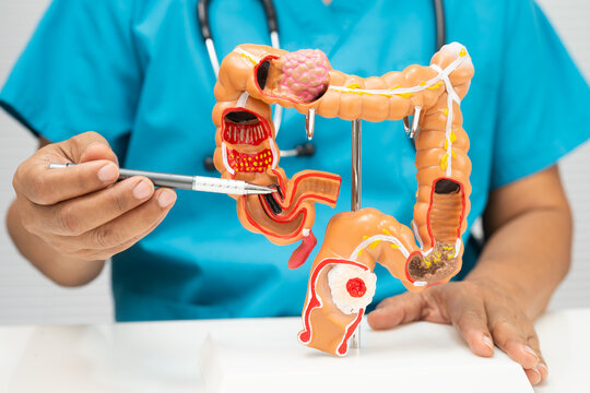 Colorectal cancer, doctor holding intestine colon human anatomy model.