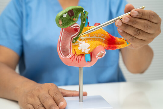 Pancreatitis, pancreatic cancer, Asian doctor with pancreas, gallbladder and bile duct human anatomy model at hospital.