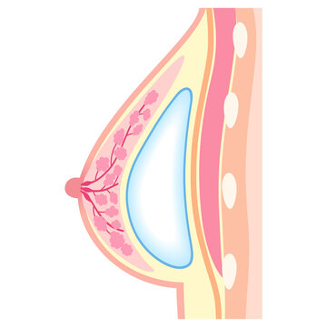 シリコンバッグを入れた胸　豊胸手術の構造　乳腺下法