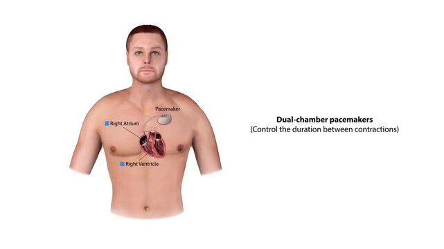 3d animation Biventricular Pacemaker Illustration for Heart Failure Patients, Anatomical Cardiac Pacing, Cardiac Resynchronization Therapy CRT , Chest and Heart Cross-Section Medical Diagram
