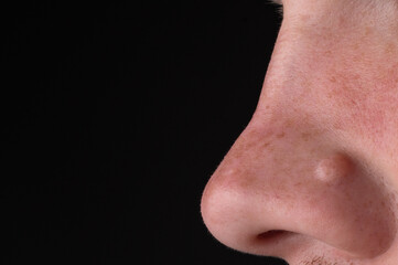 Fototapeta premium Skin bump on nose close up, skin cancer awareness and dermatology concept