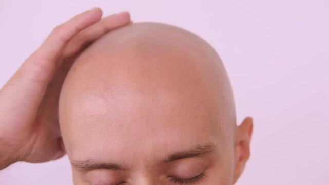 Young Bald man touching his head, eyes closed, bald patches on scalp, showing signs alopecia, healing touch, treatment hair loss, personal moment, stress relief
