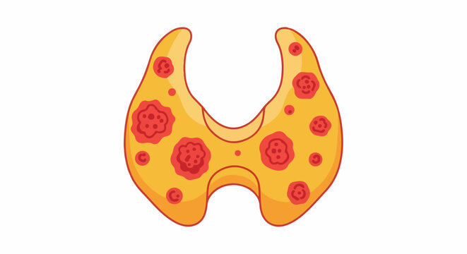 Cartoonish representation of a yellow thyroid gland with red nodules