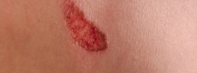Fototapeta premium Skin injury showing redness and swelling indicating possible abrasion on the body skin surface