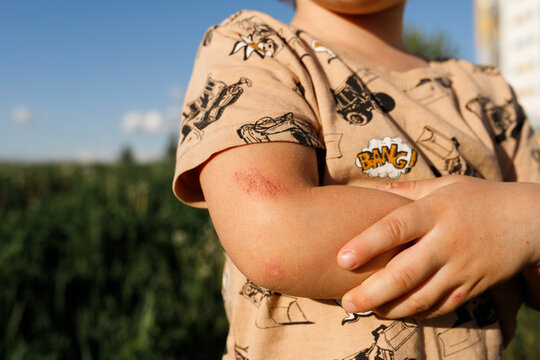 close up view of child scratched arm after falling on ground in summer field. Red skin injury, scrape, wound on toddler arm, irritation, body symptom, first aid concept, childhood accident