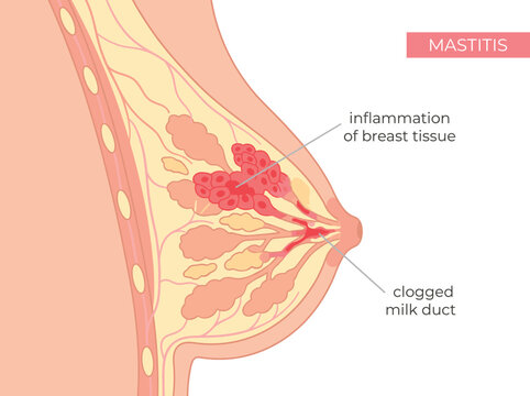 Medical illustration of mastitis in a female breast vector