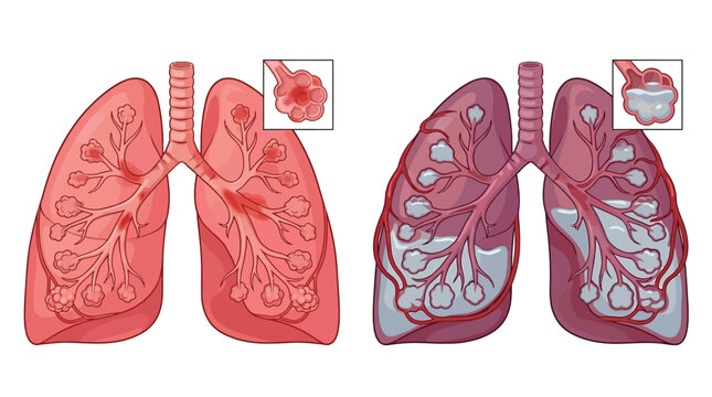 Comparison of healthy lungs and lungs with pneumonia showing inflammation and fluid accumulation in the alveoli