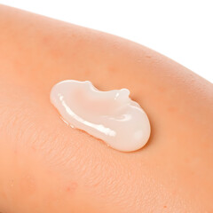 Fototapeta premium Aloe vera gel applied to sunburned skin