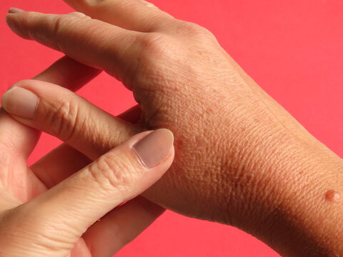 Closeup of woman hand with dark spots on pink background. Hyperpigmentation on a woman in her forties hands.