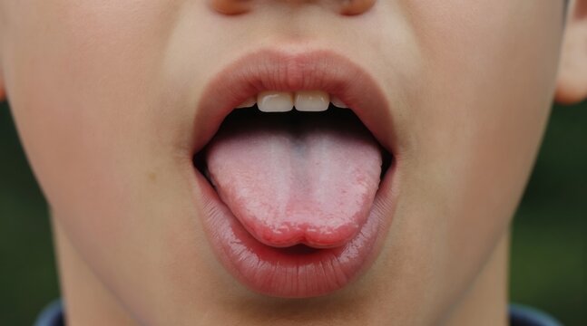 Child shows tongue with visible frenulum. Mouth open, lips parted, teeth visible. Medical condition, oral health issue. Close up, soft focus background.
