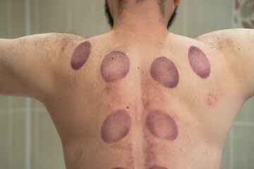 Naklejka premium Male back with hematomas marks after taking cupping therapy. After vacuum cans