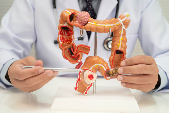Asian doctor with rectum and hemorrhoid human anatomy model at hospital, inflamed vascular structure.