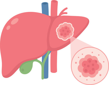 Liver Cancer Tumor Medical Vector Illustration