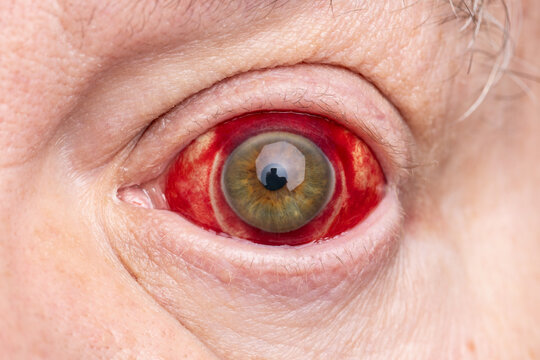 Closeup photograph of injured eyeball showing redness caused by bloody broken blood vessel of subconjunctival hemorrhage under sclera membrane