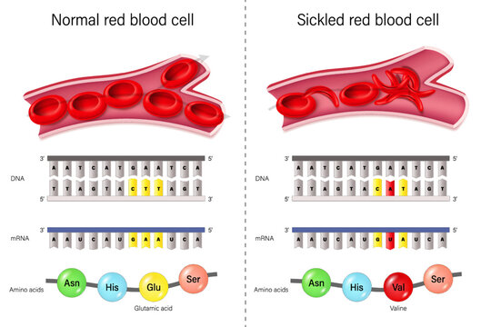 Sickle cell disease. Sickle cell anemia. Normal red blood cells and sickled red blood cells.