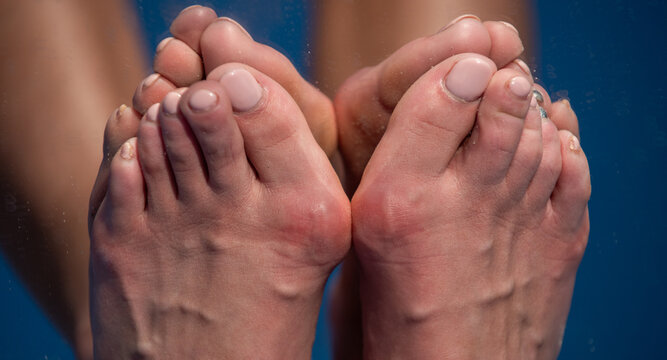 Hallux valgus deformity of big toe joint. Bare foot with Hallux valgus deformation. Human foot sole with deformities. Hallux Valgus on female legs close up. Feet of woman with hallux valgus.