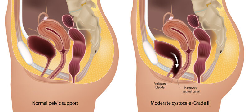 Female Pelvic Floor Anatomy Showing Grade II Cystocele and Prolapsed Bladder Cross Section Diagram. Moderate Cystocele Medical Illustration with Normal Pelvic Support Comparison and Female Pelvic 