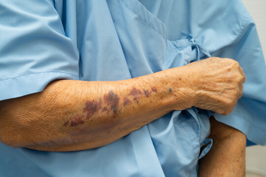 Ecchymosis, elderly bleeding on her arm after taking aspirin.