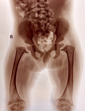X-ray of child's pelvis and upper legs. Suggestive of Rickets. Black and white view. 