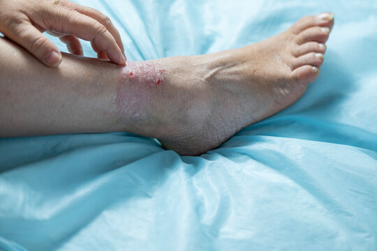 person scratches psoriatic rashes on skin with hand with chronic dermatitis, wound on painful female leg, chronic condition, dermatological disorder, skin problem, affected area