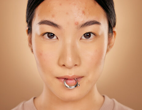 Portrait of an East Asian woman with forehead acne breakouts and a large captive bead lip piercing ring