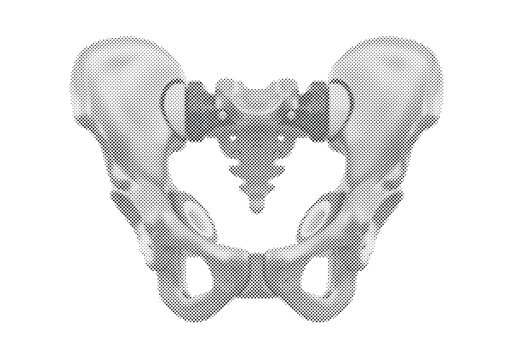 Artificial Cybernetic Pelvis 3D Render with Aerospace Titanium Plates and Ceramic Acetabulum Socket