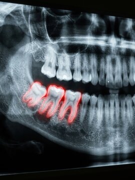 Dental X-ray Showing Tooth Abscess and Oral Health Issue in a Medical Setting