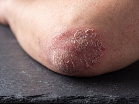 Un particolare ravvicinato di un gomito affetto da psoriasi appoggiato su una superficie scura, sulla pelle spicca una placca eritematosa ben definita ricoperta da squame argentee e secche parzialment