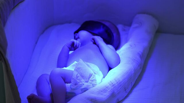 Newborn infant with neonatal jaundice receiving blue light phototherapy treatment, lying in a hospital bassinet with protective eye pads on to treat high bilirubin levels