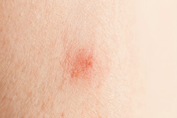 Naklejka premium Macro view shows inflamed red skin with visible pores and ingrown hair follicle. Pimple or small wound indicates skin issue or irritation. Texture reveals human epidermis detail.