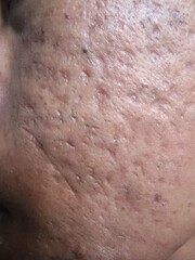 Fototapeta premium Close Up of Acne Scars and Blackheads on Facial Skin