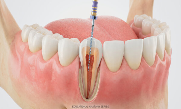 Dental anatomy model with root canal treatment