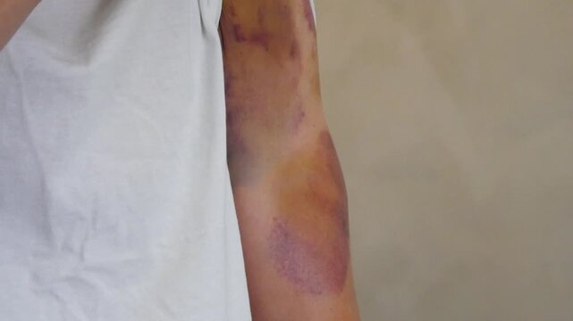 Bruise on the arm of a Man showing discoloration. Healing hematoma stages on bicep skin. Injury recovery process, skin trauma sign, medical dermatology concept.