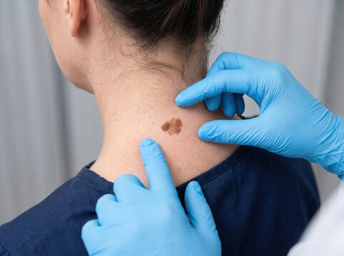 Dermatologist examining skin mole on patient neck, doctor in blue gloves checking birthmark for melanoma, clinical skin cancer screening and oncology checkup