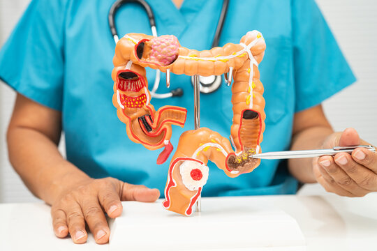 Colorectal cancer, doctor holding intestine colon human anatomy model.