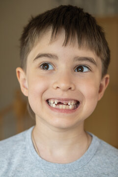 A cheerful child proudly showing a missing upper milk tooth. Concept of childhood growth, dental development, and family moments. Perfect for pediatric dentistry, tooth loss. 