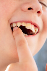 Fototapeta premium Close up child mouth showing damaged tooth and pointing finger, dental health problem, cavity and poor oral hygiene, pediatric dentistry, need for treatment, tooth decay awareness, dentist visit