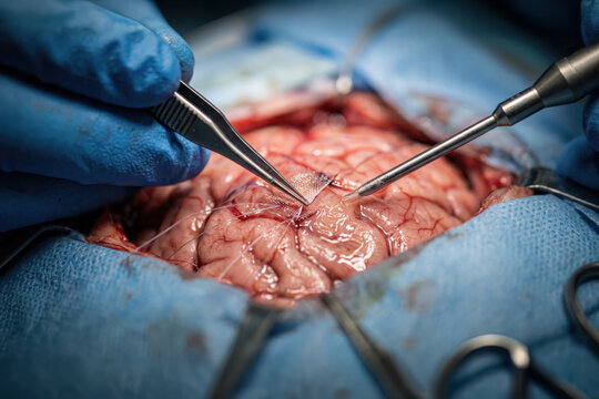 Neurosurgical craniotomy procedure with placement of a hemostatic mesh on the brain surface