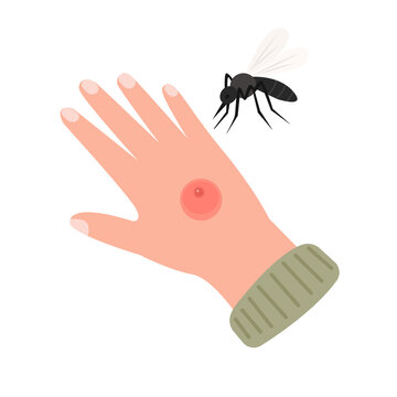 The human hand with the mosquito bite.Itch, allergy, red marks from insect bites. Dermatology problems, allergic reaction on body.Vector Illustration