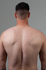 Naklejka premium The young man's back is covered with pimples and irritations. Concept: skin diseases caused by the use of chemicals, malnutrition and stress at work. Treatment of acne in adolescents