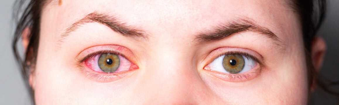 Close up of a young woman red, irritated eye from conjunctivitis. Medical exam needed. Ophthalmologist consultation, eye drops prescription. Vision check urgency for clinic advertising