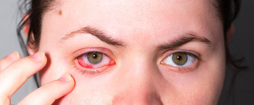 Red eye due to viral or bacterial infection. Eye doctor examining inflamed conjunctiva. Medical clinic photography for health articles