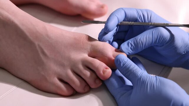 Podiatrist examining client's nail bed on foot with chisel tool indoors, closeup