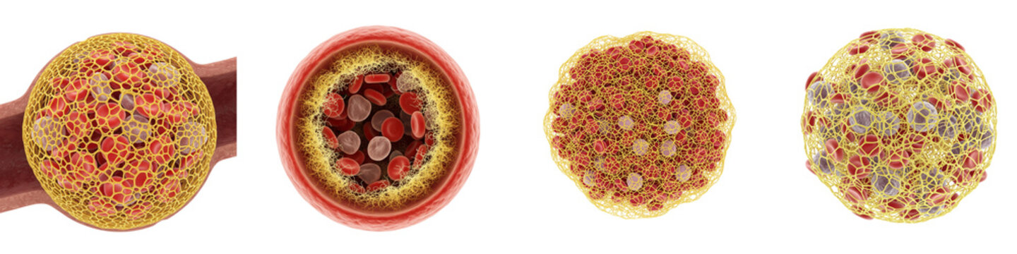 3D medical illustration showing blood clot formation with fibrin mesh and cells
