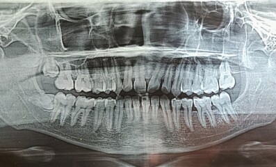 A panoramic dental X-ray film showing human teeth, jawbone structure, wisdom teeth, and standard medical imaging details for orthodontic diagnosis © Sandry