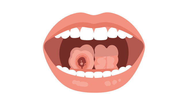 Medical illustration of open human mouth showing painful lesions or ulcers on surface of tongue for dental diagnosis.
